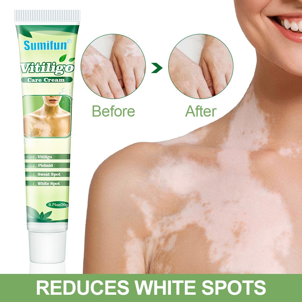 Sumifun Vitiligo & White Spot Removal Cream – Skin Melanin Repair - Image 2