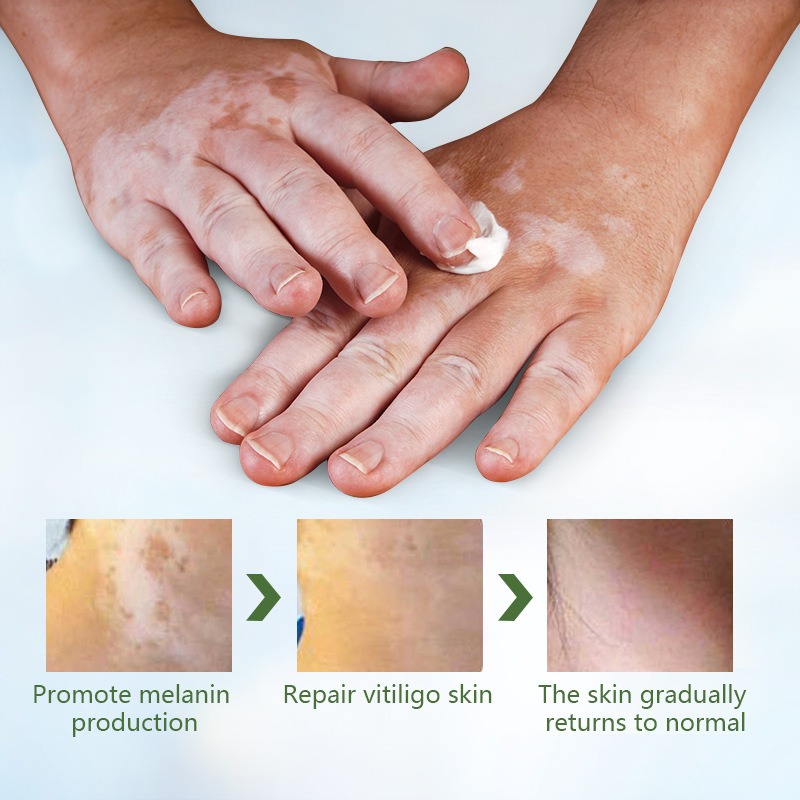Sumifun Vitiligo & White Spot Removal Cream – Skin Melanin Repair - Image 4
