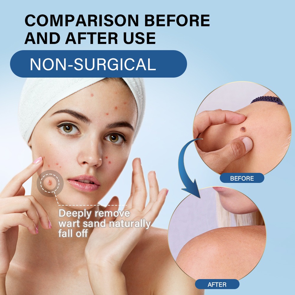Sumifun Wart Removal Cream For Common Warts Safe & Effective Skin Tag Remover for Body & Face - Image 4
