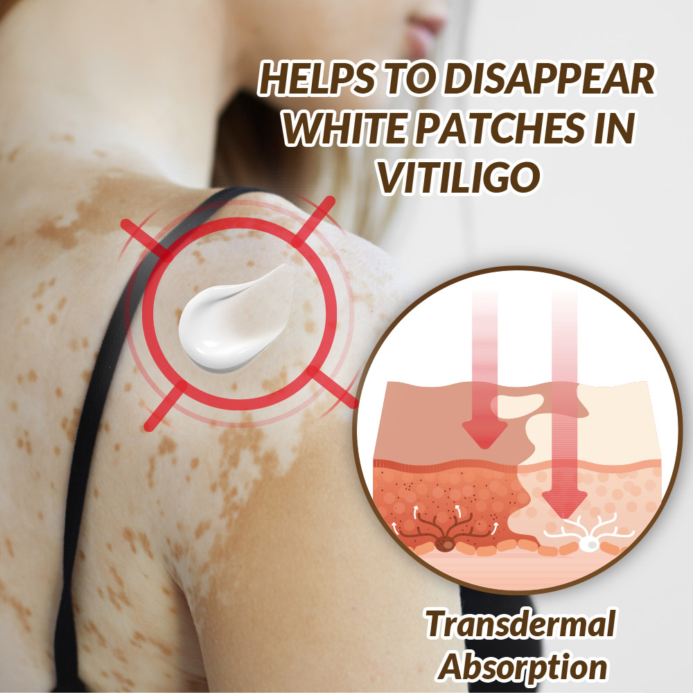 Sumifun Vitiligo Care Cream 30ml | Pigmentation Care Cream | Botanical Skin Care Formula | Daily Skin Care | External Use - Image 2